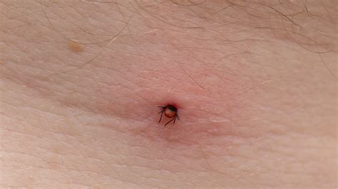 What Do Tick Bites Look Like on Humans? See Pictures - GoodRx