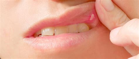 Oral Herpes Inside Lips Canker Sore Vs. Cold Sore: Telling The