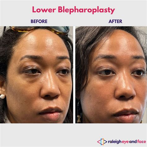 Lower Blepharoplasty (Eye Bag Surgery) Raleigh NC | Pradeep Mettu, MD — Raleigh Eye and Face