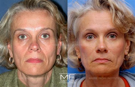Nasolabial Folds Before and After Pictures Case 897 | San Francisco, CA | Mabrie Facial Institute
