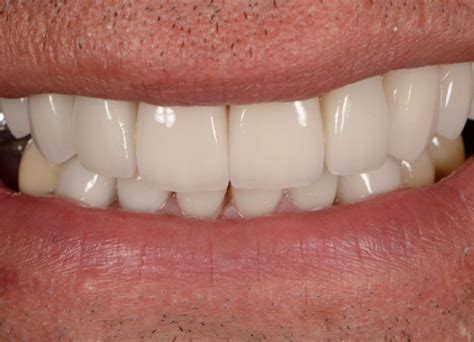 Gum Abscess Popped? Thinking of Popping It Yourself?