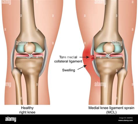 Ligament collatéral médial Stock Vector Images - Alamy