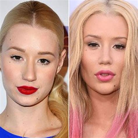 Iggy Azalea Plastic Surgery Before And After