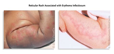 Reticular Rash Fifth Disease