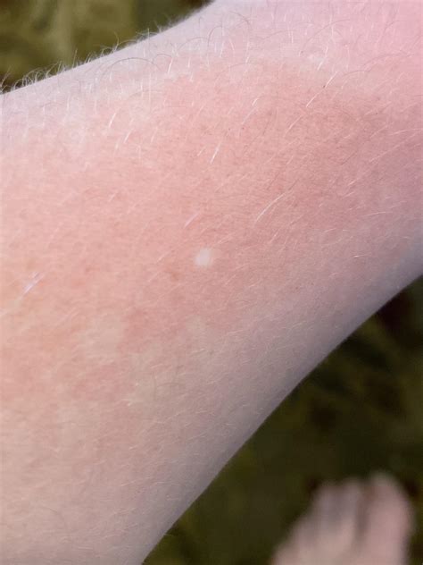 Any reason for concern with this small white dot on my arm?? : r ...