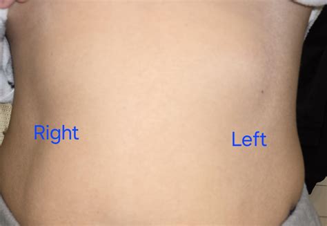 80 best Lipoma images on Pholder | Lipoma, Old Man Dog and Medizzy