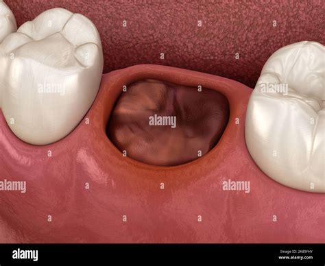 The blood clot seals off the tooth after extraction. Medically accurate 3D illustration Stock ...