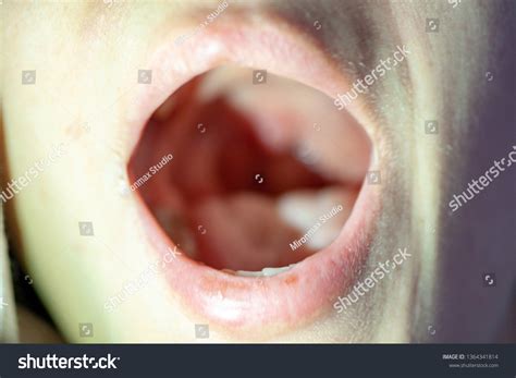 Blisters In Throat