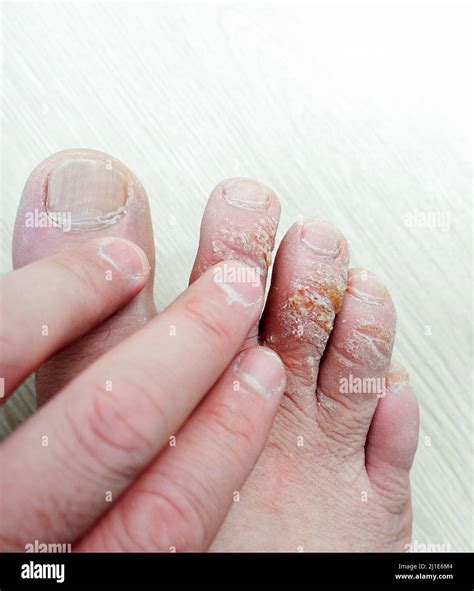 close-up foot skin diseases, callus formation on the fingers, calluses on the upper part of the ...