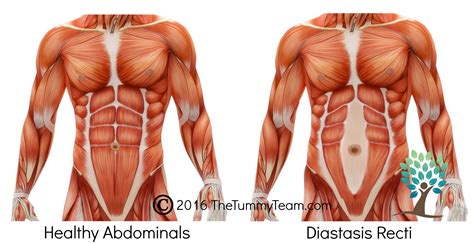 Diastasis Rectus Repair - Electrical Panel Repair