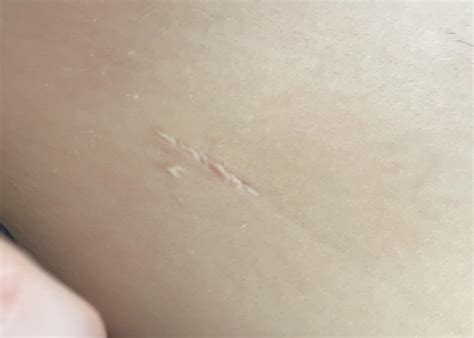 Appendicitis scar, 9 months old : r/scars