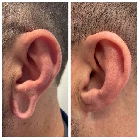 Earlobe Plastic Surgery Before and After | Earlobe Repair Before and After | St. Louis, Missouri