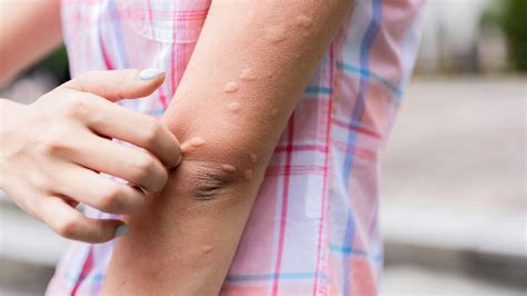 Understanding Chronic Hives - Sharecare