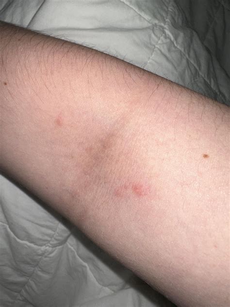 Rash on inner elbow : r/Hypochondriacs
