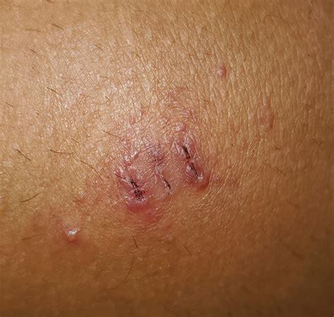 Removed my stitches today and I have this weird itchy rash/irritation ...