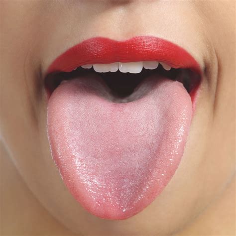 Anemia Tongue