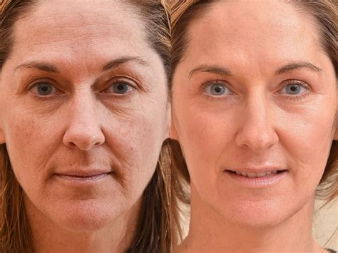 Fractionated Co2 Laser CO2 Laser Skin Resurfacing With Sculptra Facial