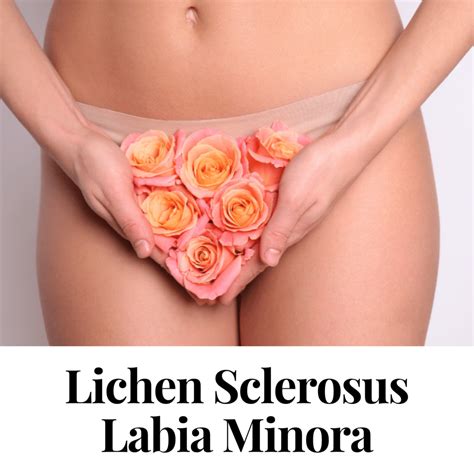 Lichen Sclerosus Labia Minora | Private Treatment UK