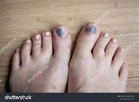 Trauma Nail Treatment