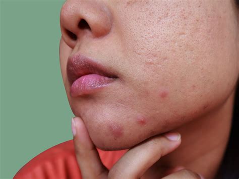 What Causes Chin Acne and How to Treat It, According to Dermatologists ...
