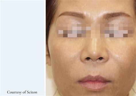 Photofacial in Cincinnati | BBL Hero & Forever Young BBL | Amy Brenner, MD