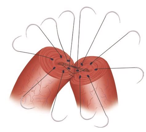 Vasectomy reversal (vasovasostomy) — Montreal and Quebec City — Dr. Marois