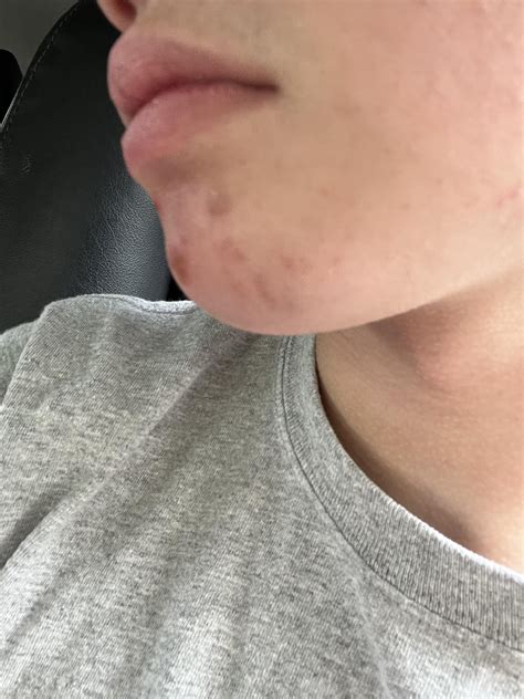 What is this hard lump on my chin? It keeps reappearing. This is one of the smaller and less ...