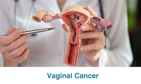 Vaginal Cancer - Proton Therapy