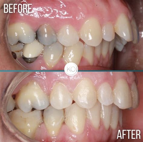 Discover How Braces Effectively Correct Overbites