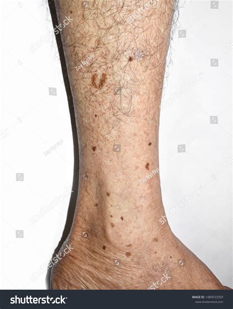 643 Senile leg 이미지, 스톡 사진 및 벡터 | Shutterstock