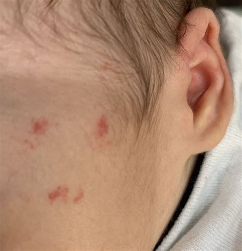 red spots on baby face - Hode Geek