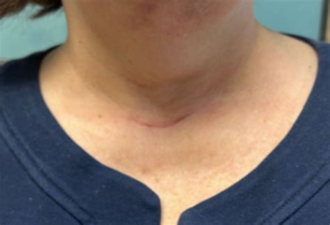 Thyroid surgery - Westchester, New York | Northwell Health