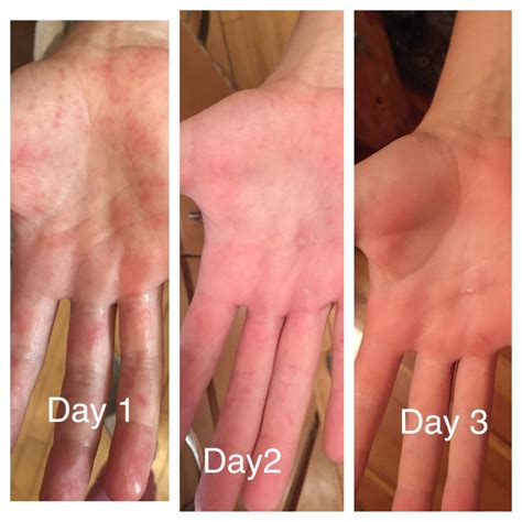 Hand foot and mouth remedies – Artofit