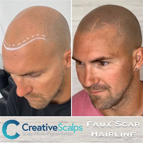Faux Scar hairline scalp micropigmentation style by Creative Scalps