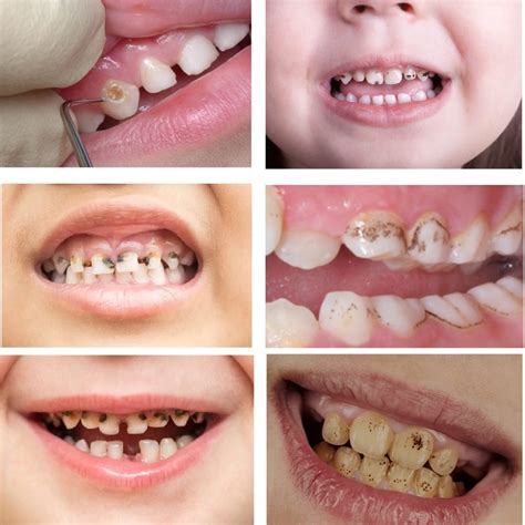 Rotten Teeth: Causes, Symptoms, Treatment, and Prevention