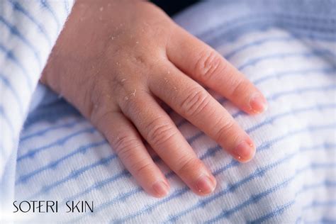 Newborn Skin Peeling: Causes, Timeline & Safe Care Tips