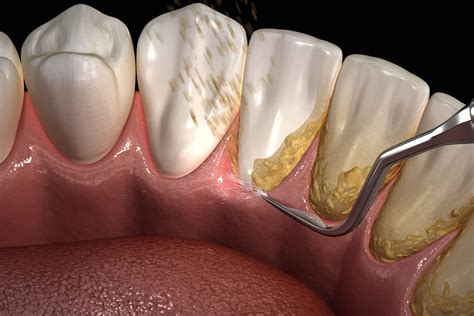 Types Of Dental Tartar at Deborah Vann blog