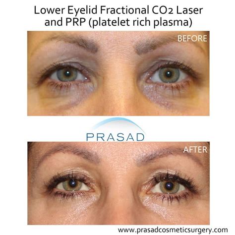Best Under Eye Treatment