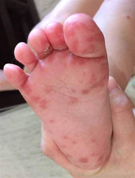 Hand Foot Mouth Diaper Rash