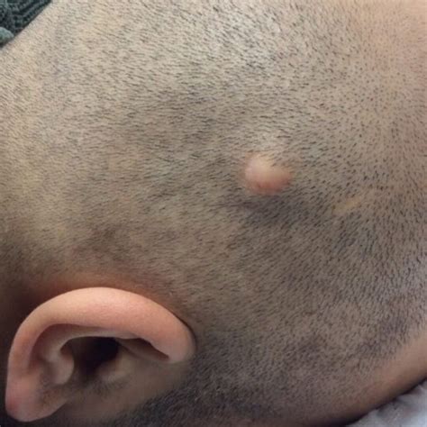 Pilar Cyst Removal: Causes, Treatment Options, and Recovery