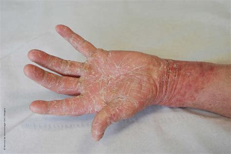 Eczema o micosis? | Fundación Eczema