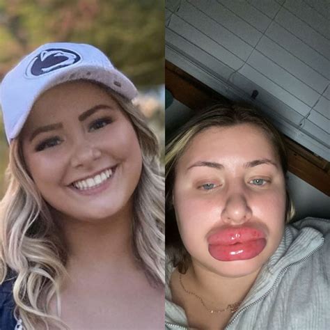 Woman's lips swells to 'eight times the normal size' after allergic reaction to fillers