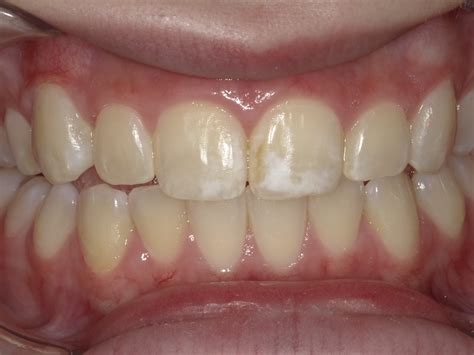 What Causes White Spots On Teeth? – VBCTN