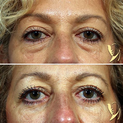 Lower Eyelids Blepharoplasty Before After 60 | Robinson FPS