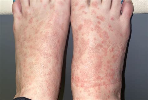 Itchy Rash on feet that is non responsive to Steroid creams. It's been ...