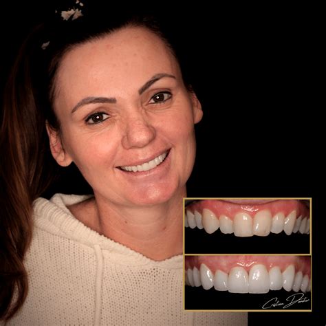 Costs of Veneers in Australia | ArtSmiles Dentistry