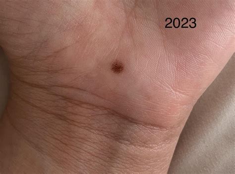 Mole on palm that constantly changes. Why? : r/DiagnoseMe