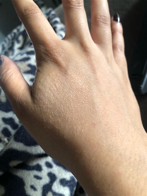 Why Do I Have Small White Spots On My Hands at Marcus Dacomb blog