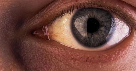 Yellow Eyes: Conditions That Cause in Newborns, Children, and Adults