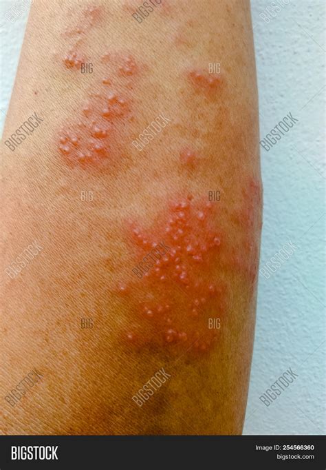 Herpes On Arms